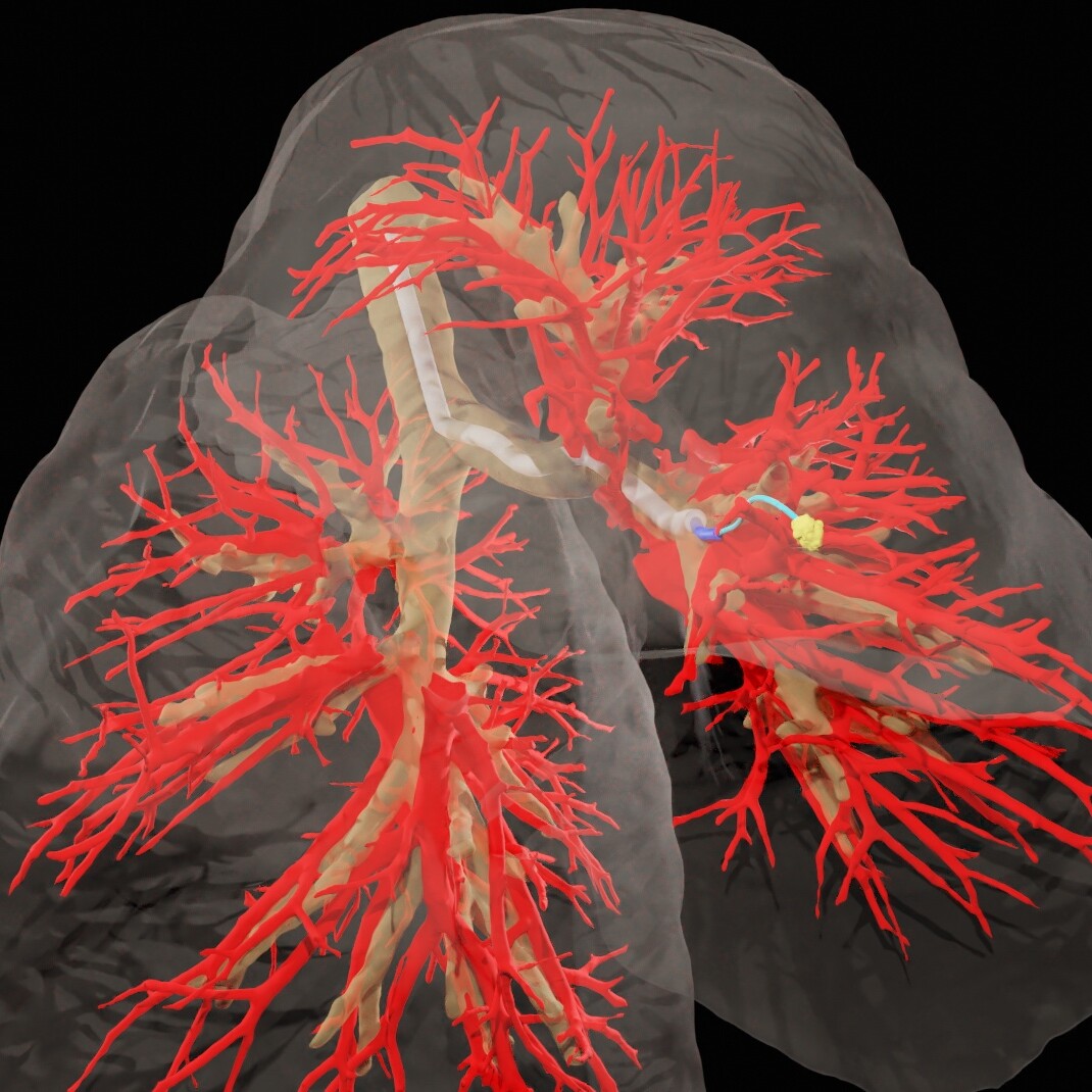 A 3D map of lung structure, showing how the researchers steerable needle makes its way to a target nodule