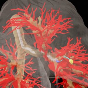 A 3D map of lung structure, showing how the researchers steerable needle makes its way to a target nodule