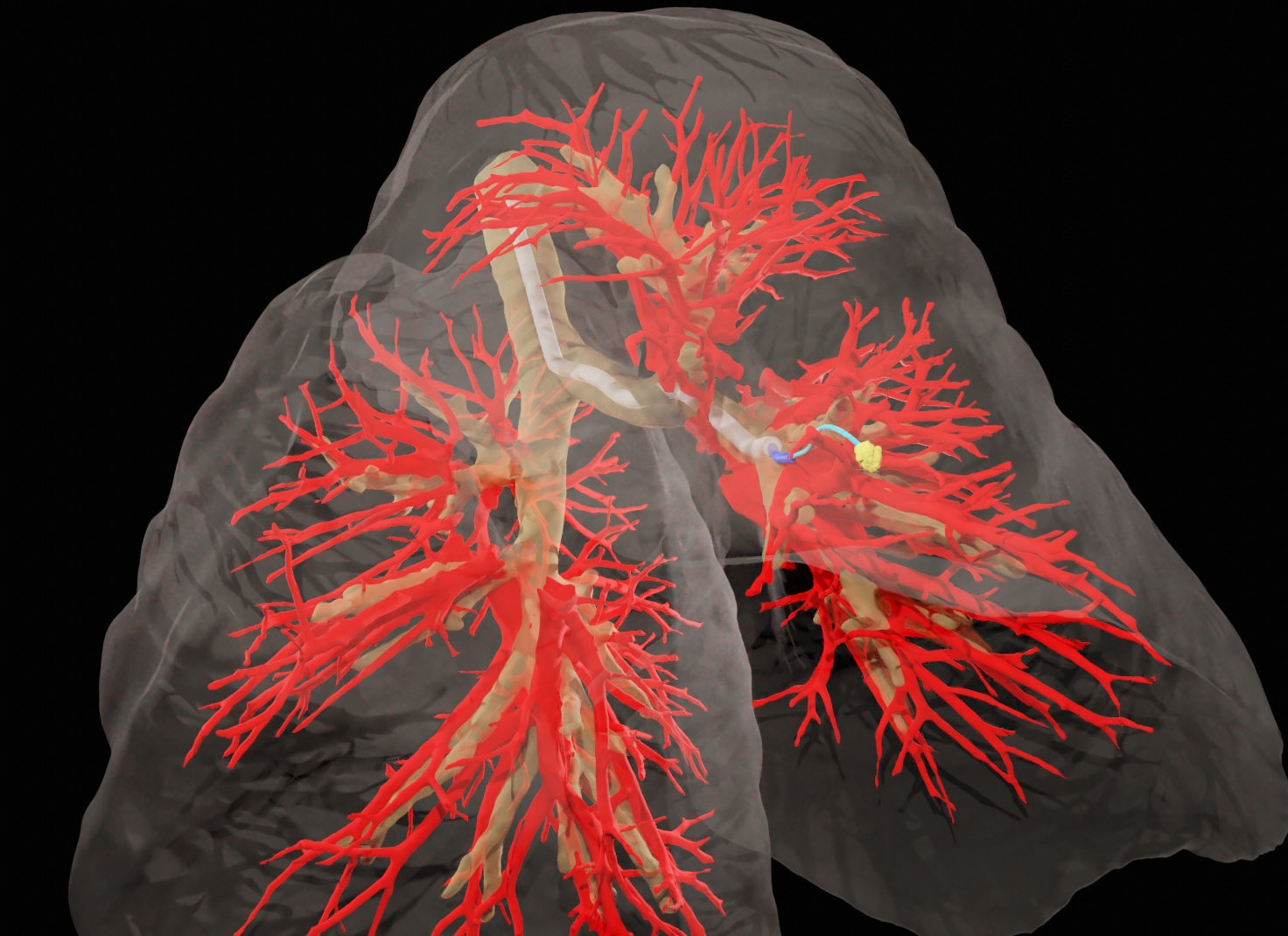 A 3D map of lung structure, showing how the researchers steerable needle makes its way to a target nodule